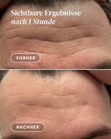 Patches para el Entrecejo con Aloe Vera