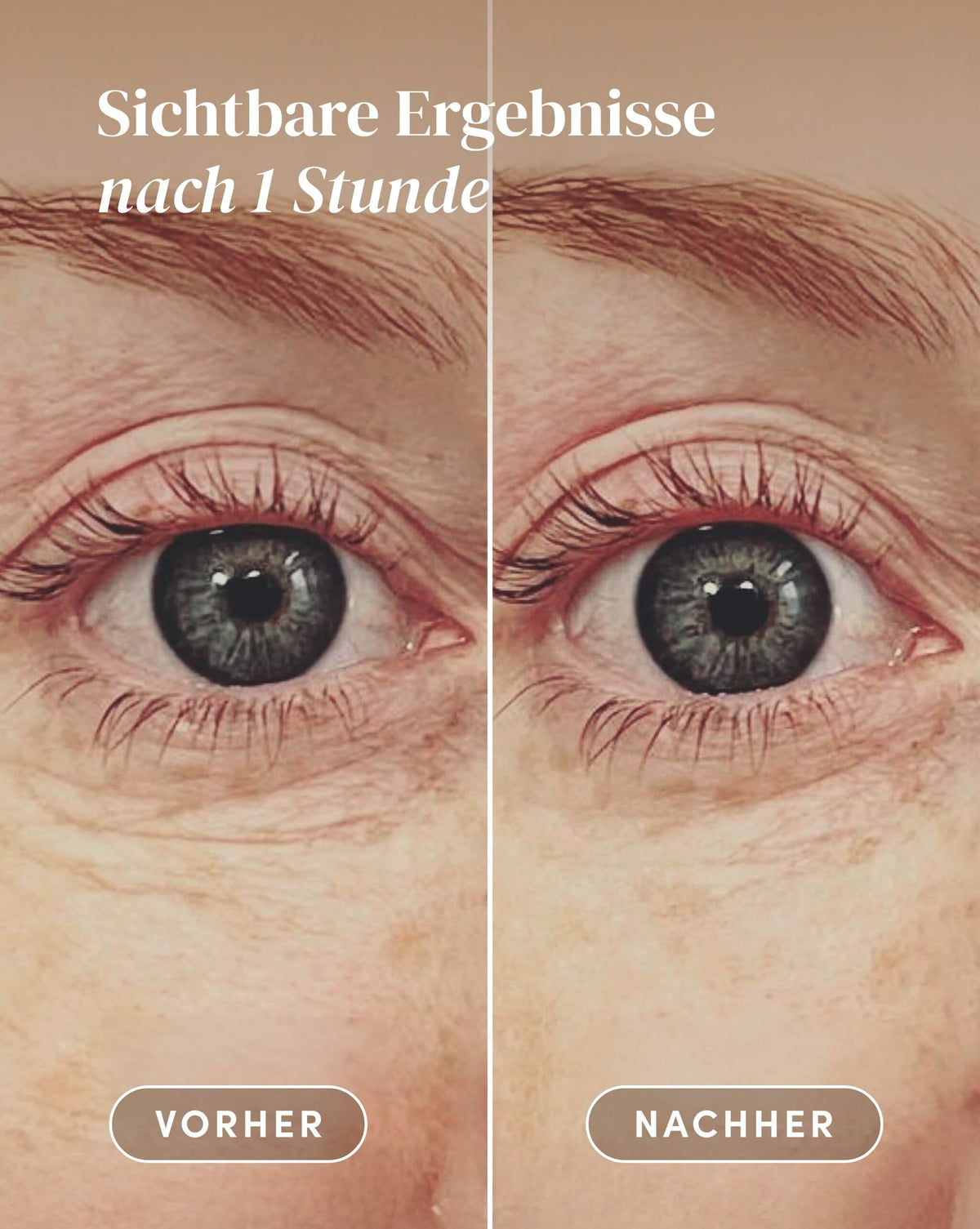 Vorher-Nachher-Ergebnis nach Anwendung der Hyaluron Augenpads