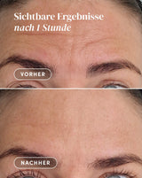 Pads para la frente con ácido hialurónico