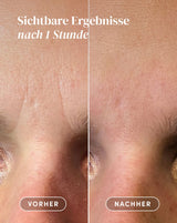 Patches para el Entrecejo con Ácido Hialurónico