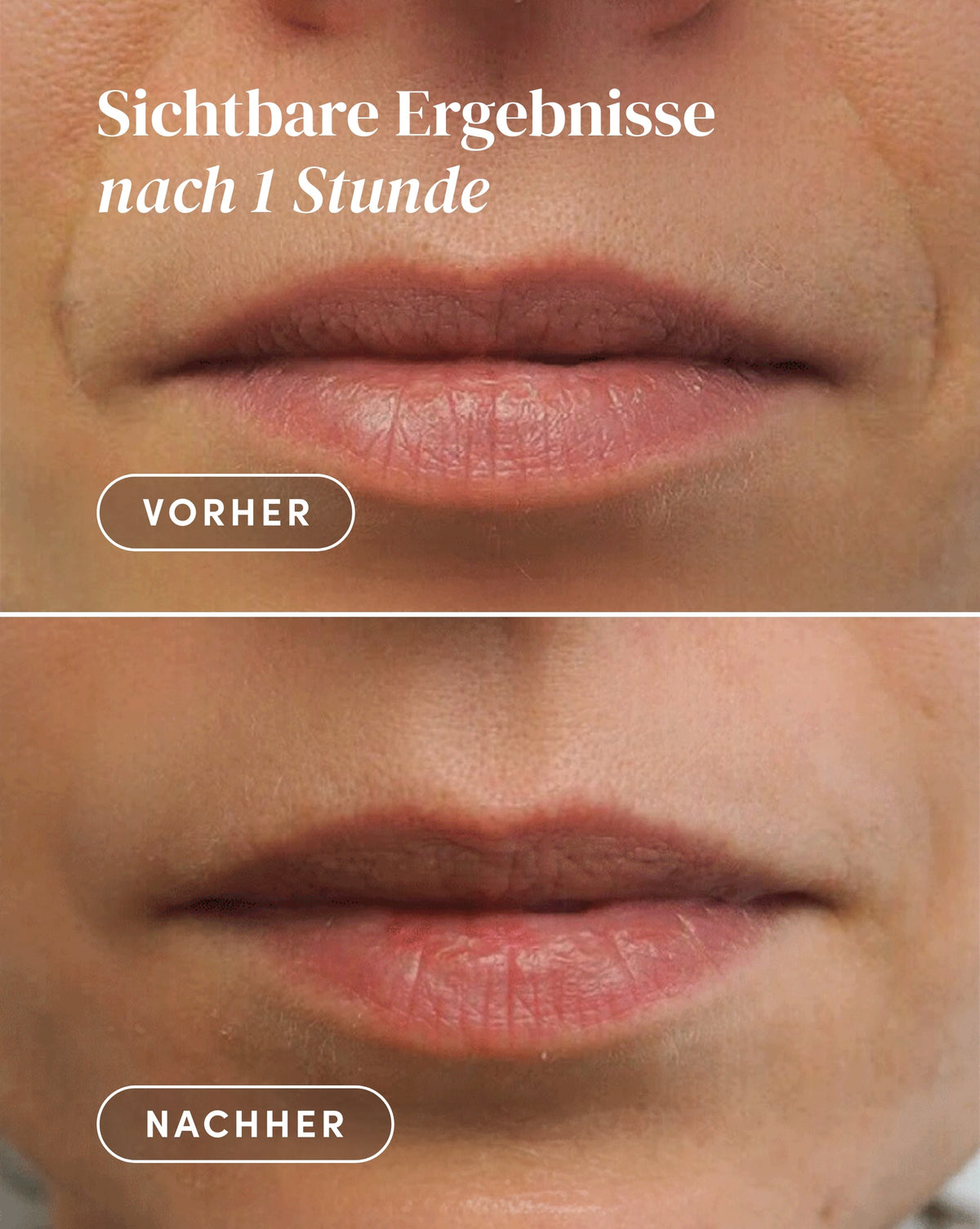 Vorher-Nachher-Ergebnis nach Anwendung der Niacinamid Mund Patches aus Bio-Baumwolle