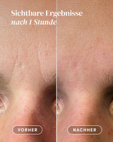 Vorher-Nachher-Ergebnis nach Anwendung der Panthenol Zornesfalten Patches aus Bio-Baumwolle