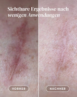 Pads para Cicatrices con Aloe Vera