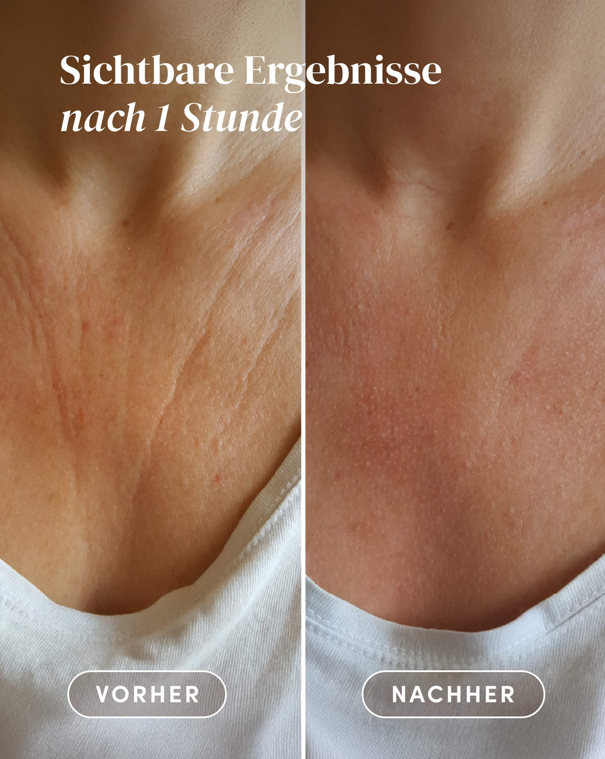 Vorher-Nachher-Ergebnis nach Anwendung des Hyaluron Dekolleté Pad