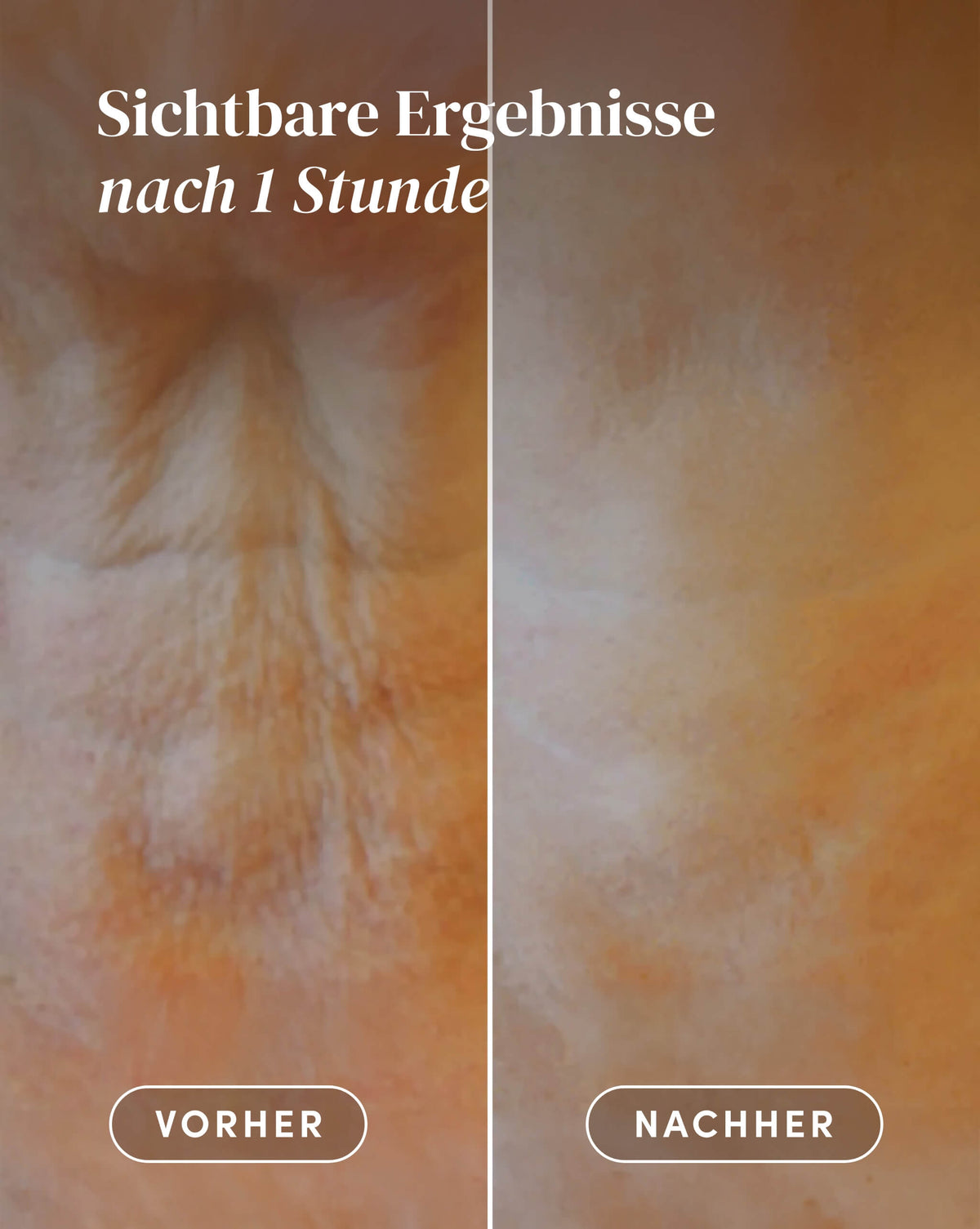Vorher-Nachher-Ergebnis nach Anwendung des Hyaluron Hals Pad