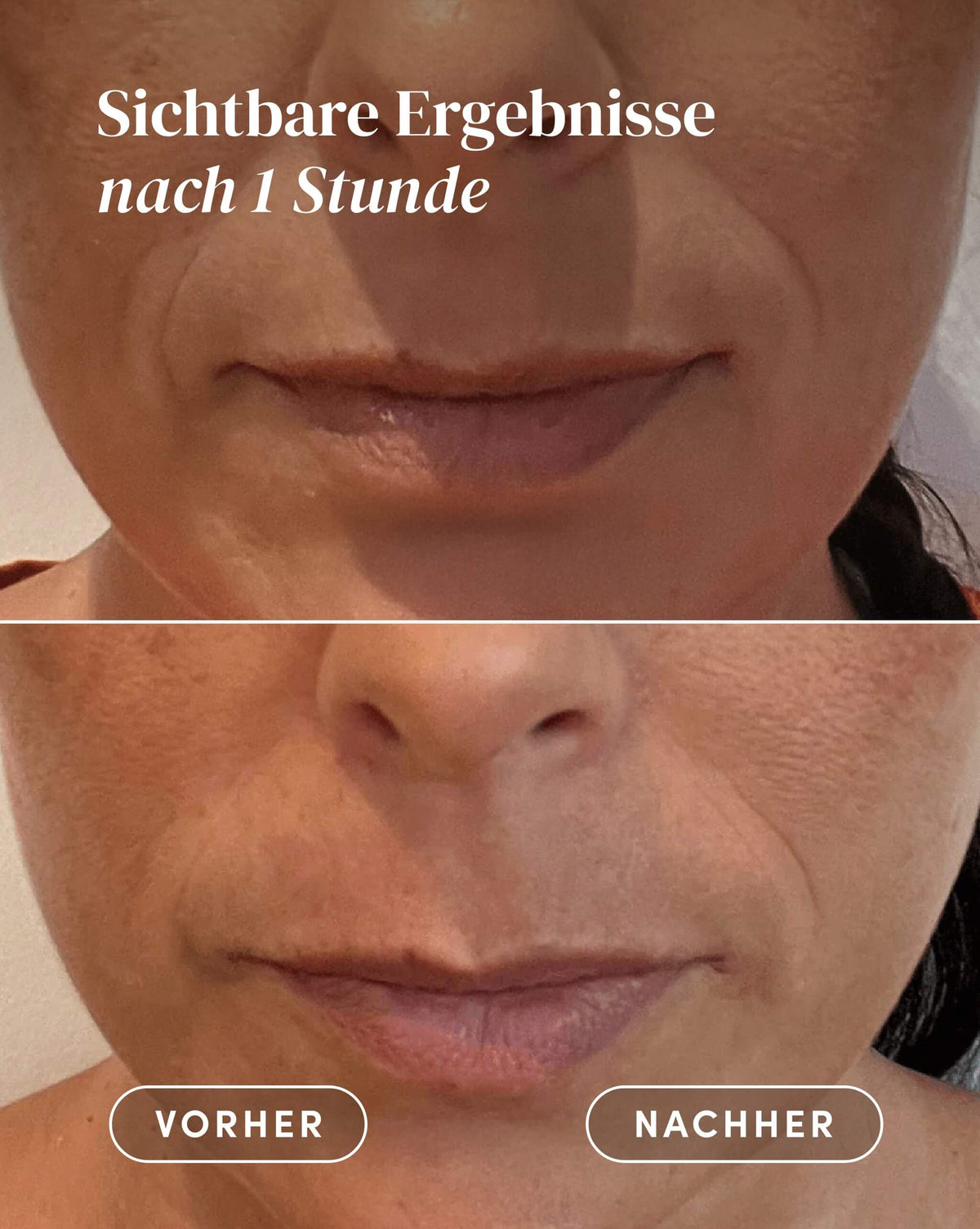 Vorher-Nachher-Ergebnis nach Anwendung der Hyaluron Mund Pads