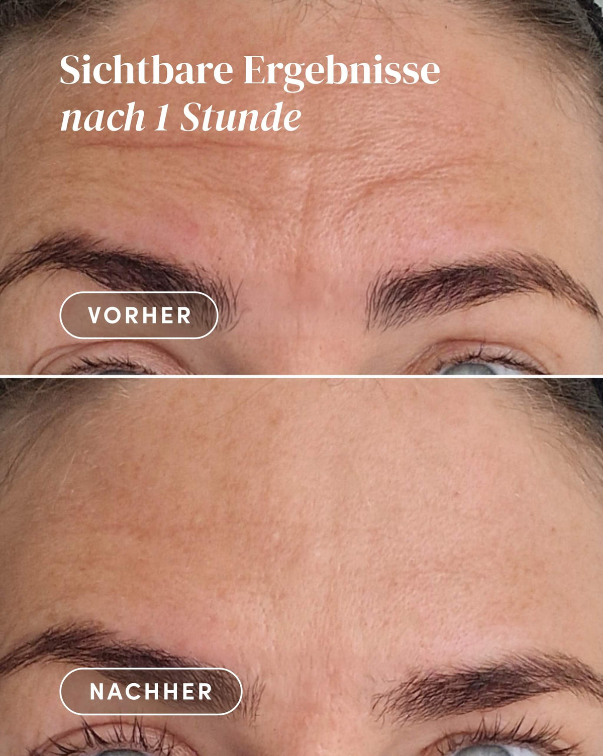 Vorher-Nachher-Ergebnis nach Anwendung des Hyaluron Stirn Pad
